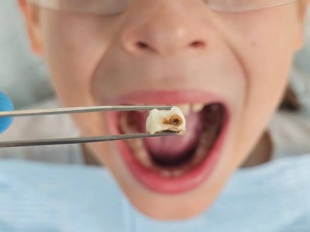 Best Dentist for Tooth Abscess  in Louisburg, KS